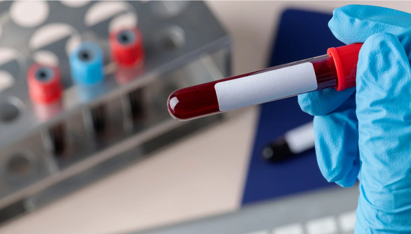 Profesional de la salud preparando una muestra para una biometría hemática